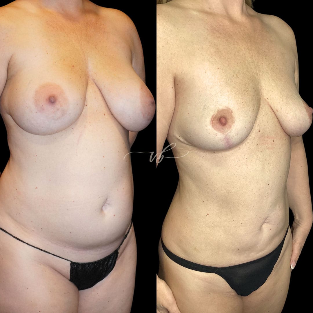 Liposuction before and after