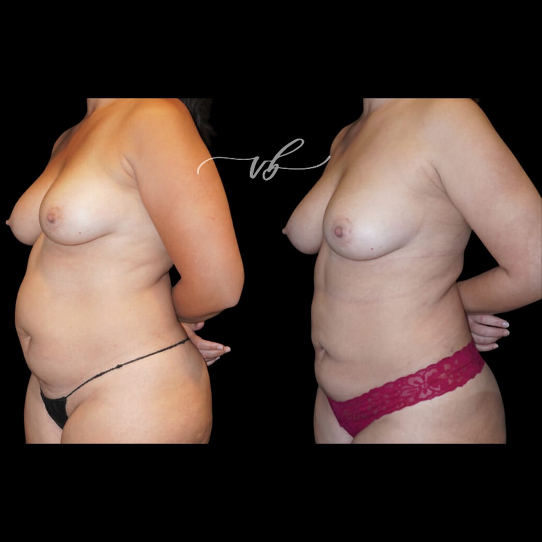Liposuction before and after