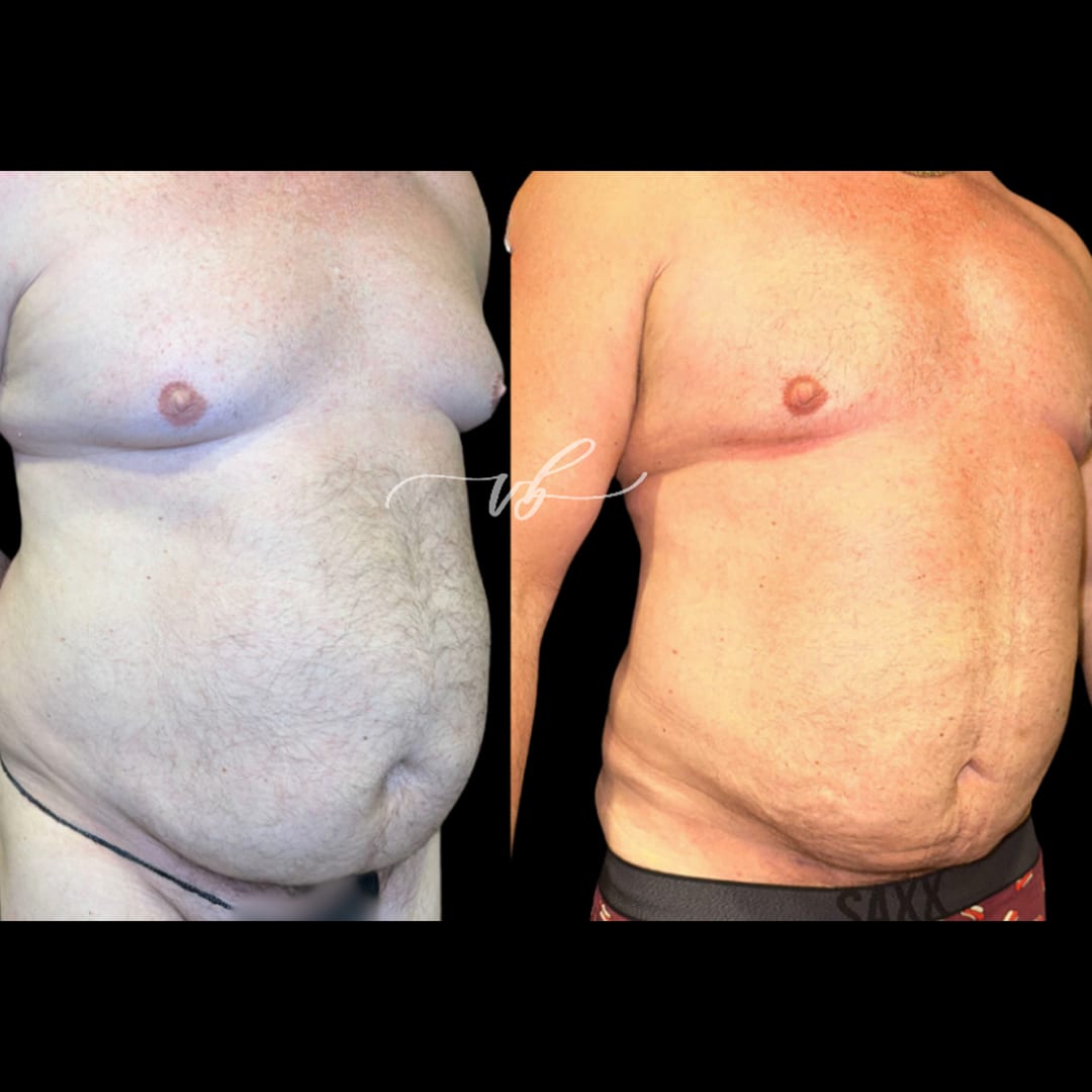 Liposuction before and after