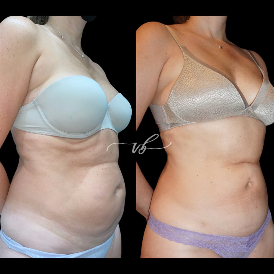 Liposuction before and after