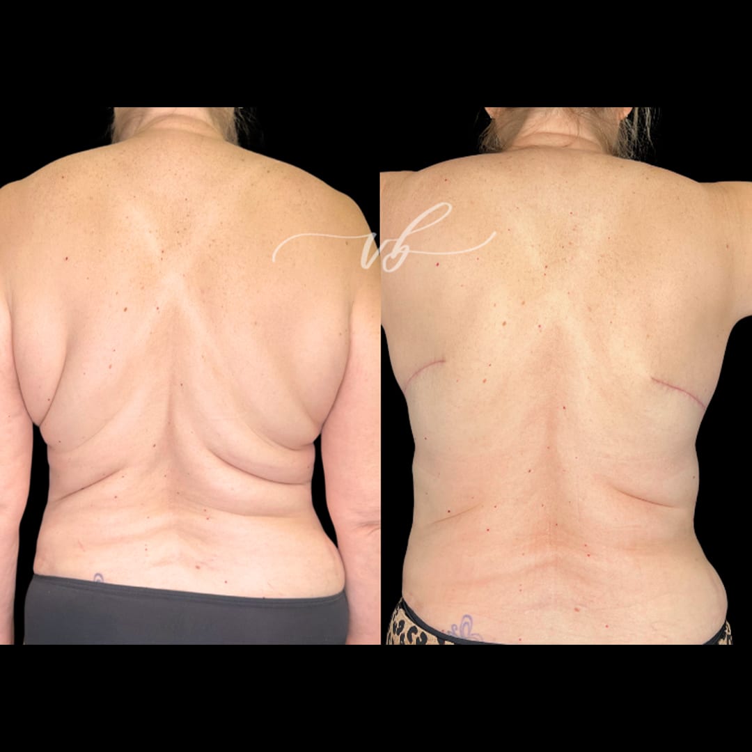 Liposuction before and after