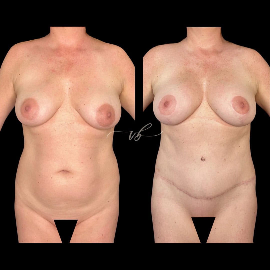 Mommy Makeover before and after
