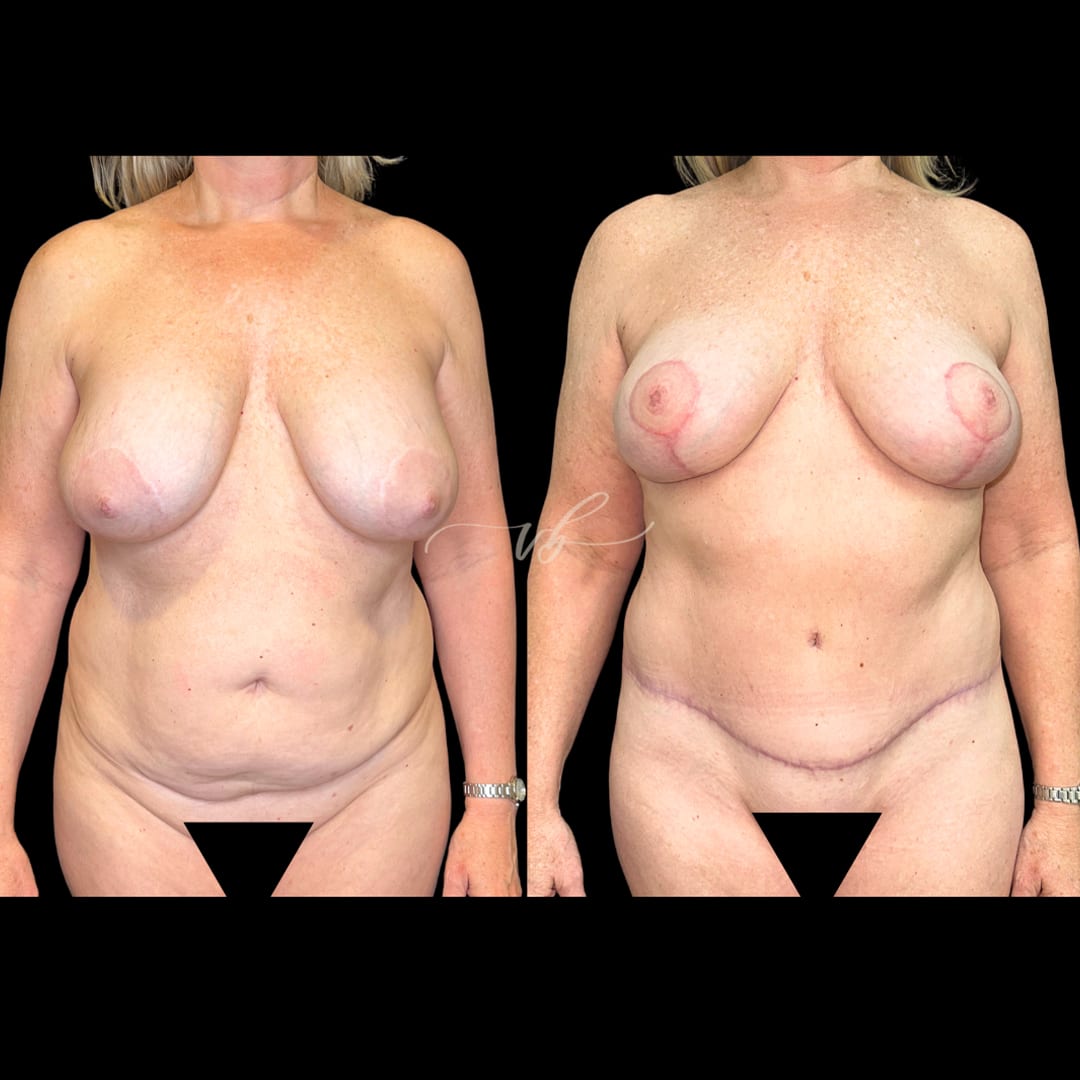 Mommy Makeover before and after