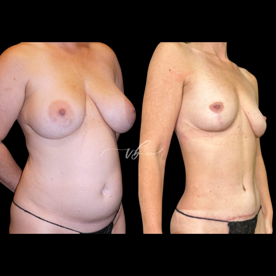 Mommy Makeover before and after