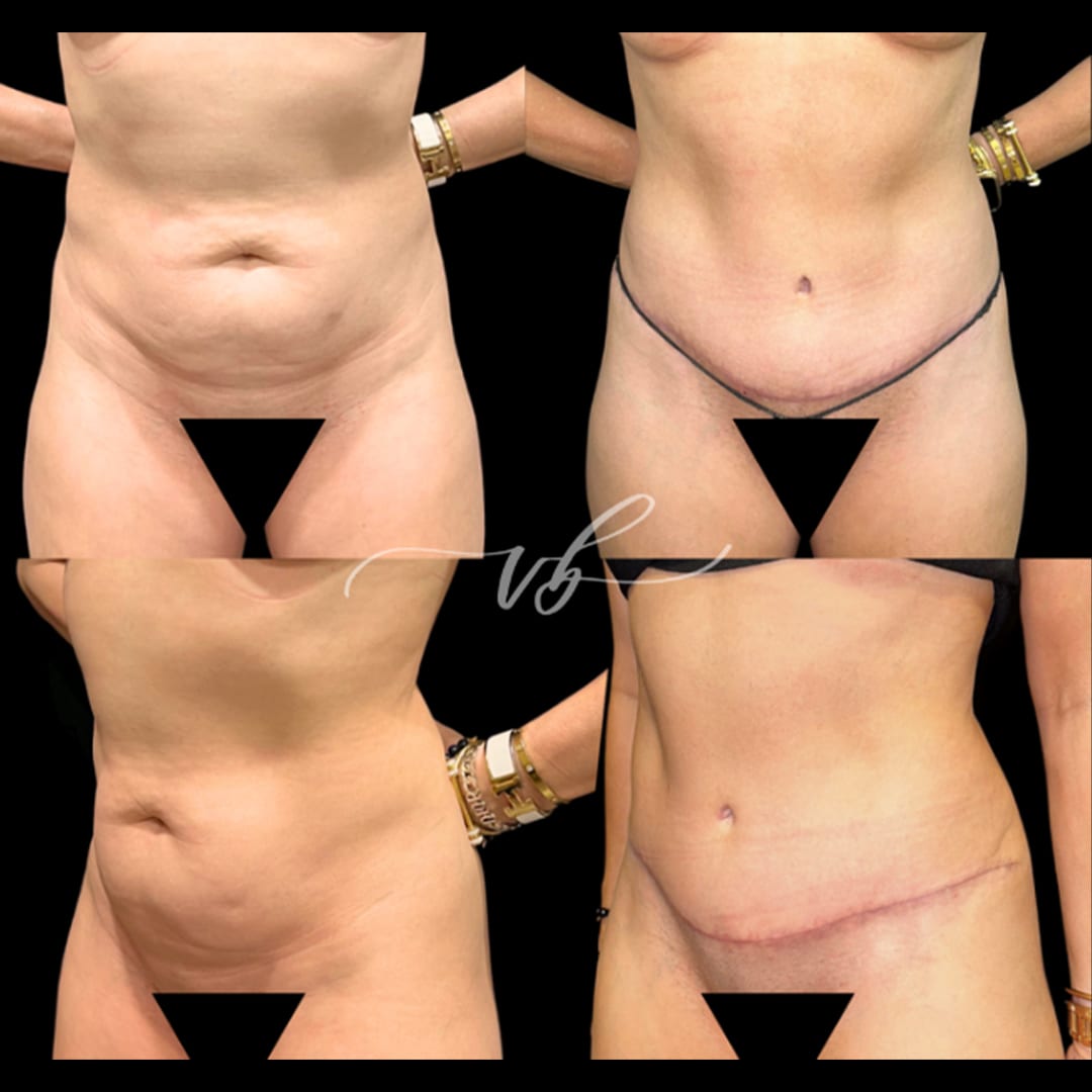 Mommy Makeover before and after