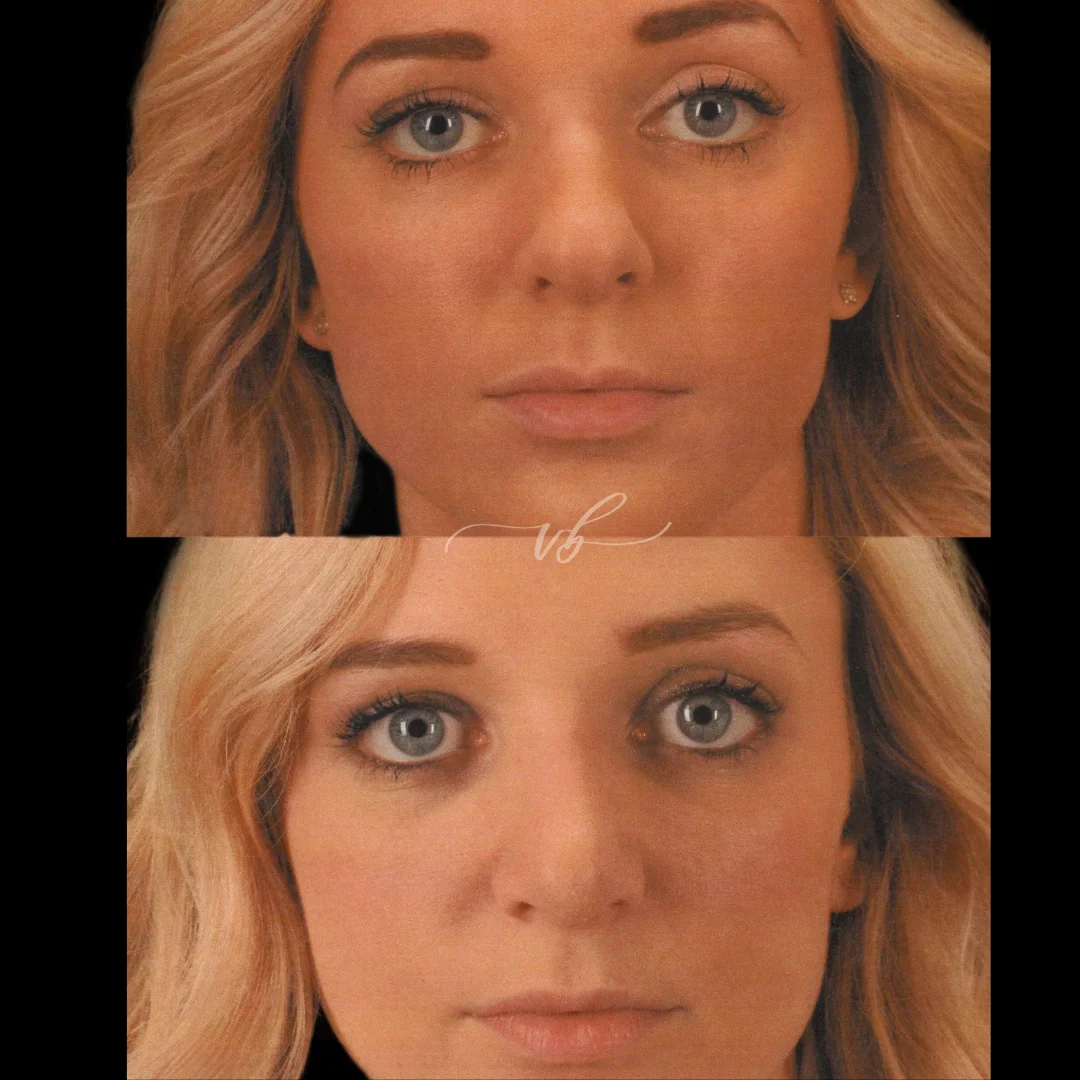 Rhinoplasty before and after