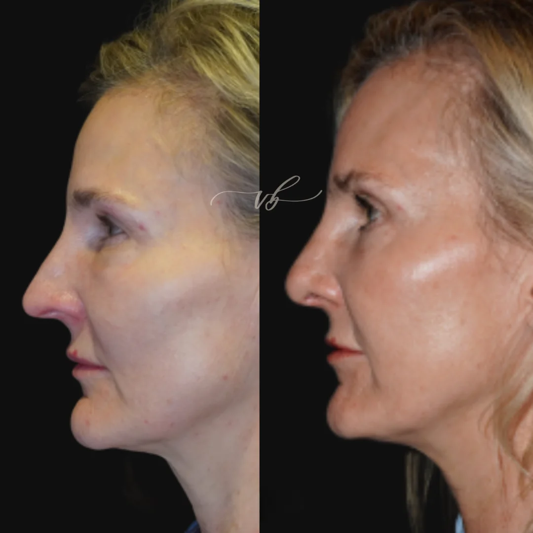 Rhinoplasty before and after