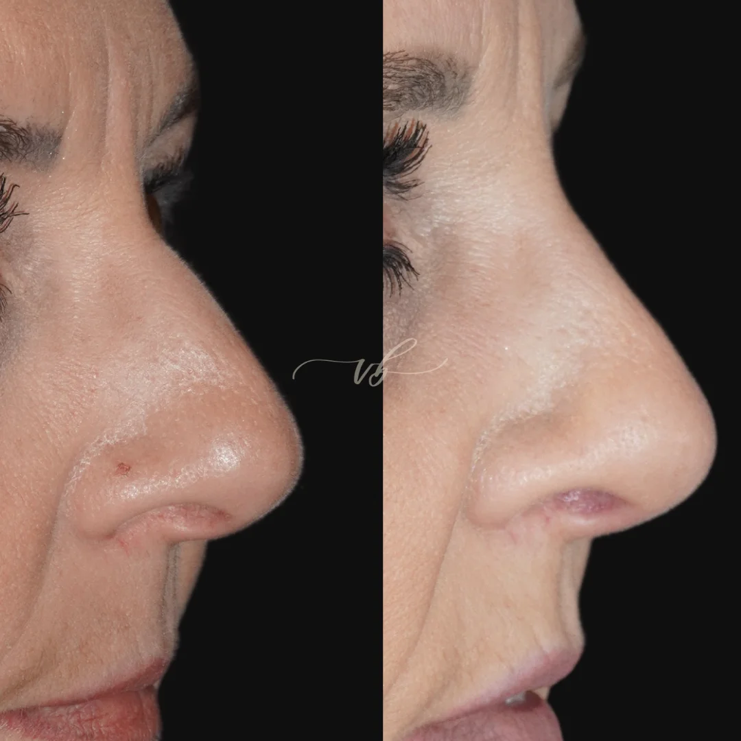Rhinoplasty before and after