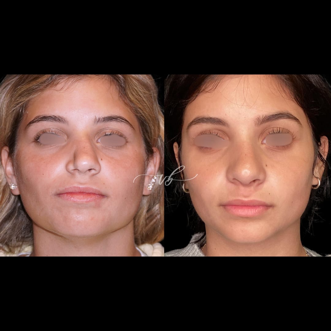 Rhinoplasty before and after
