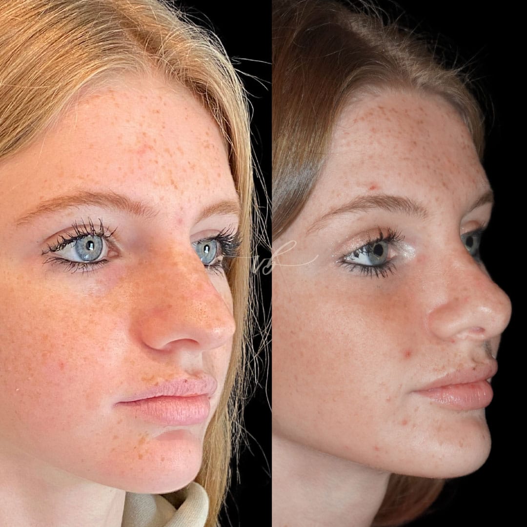 Rhinoplasty before and after