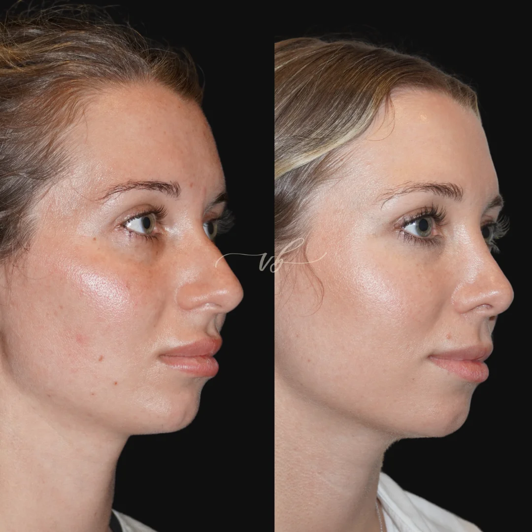 Rhinoplasty before and after