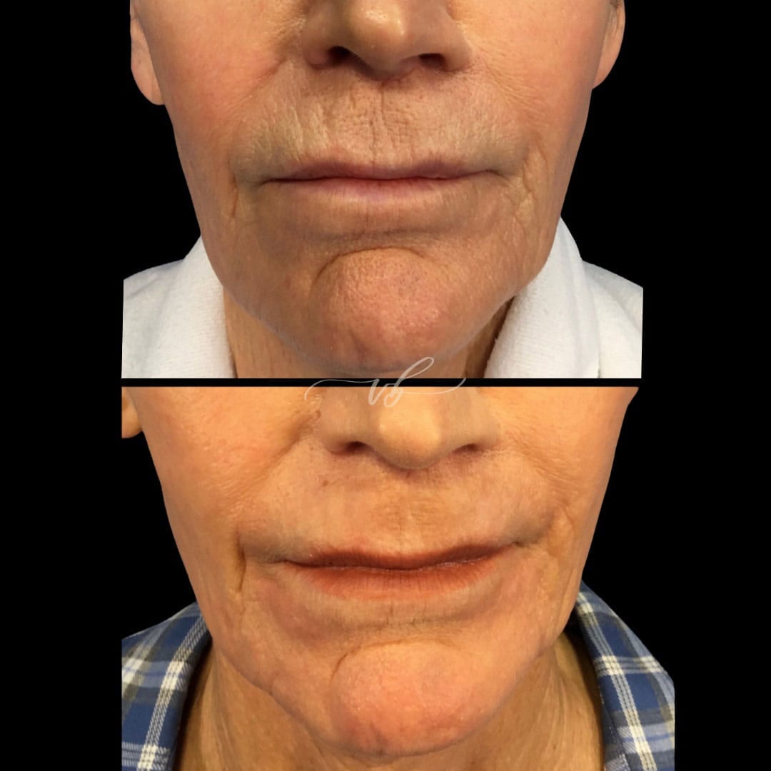 Before and after laser skin resurfacing for lines and sun damage at Vida Bela Laser Center.
