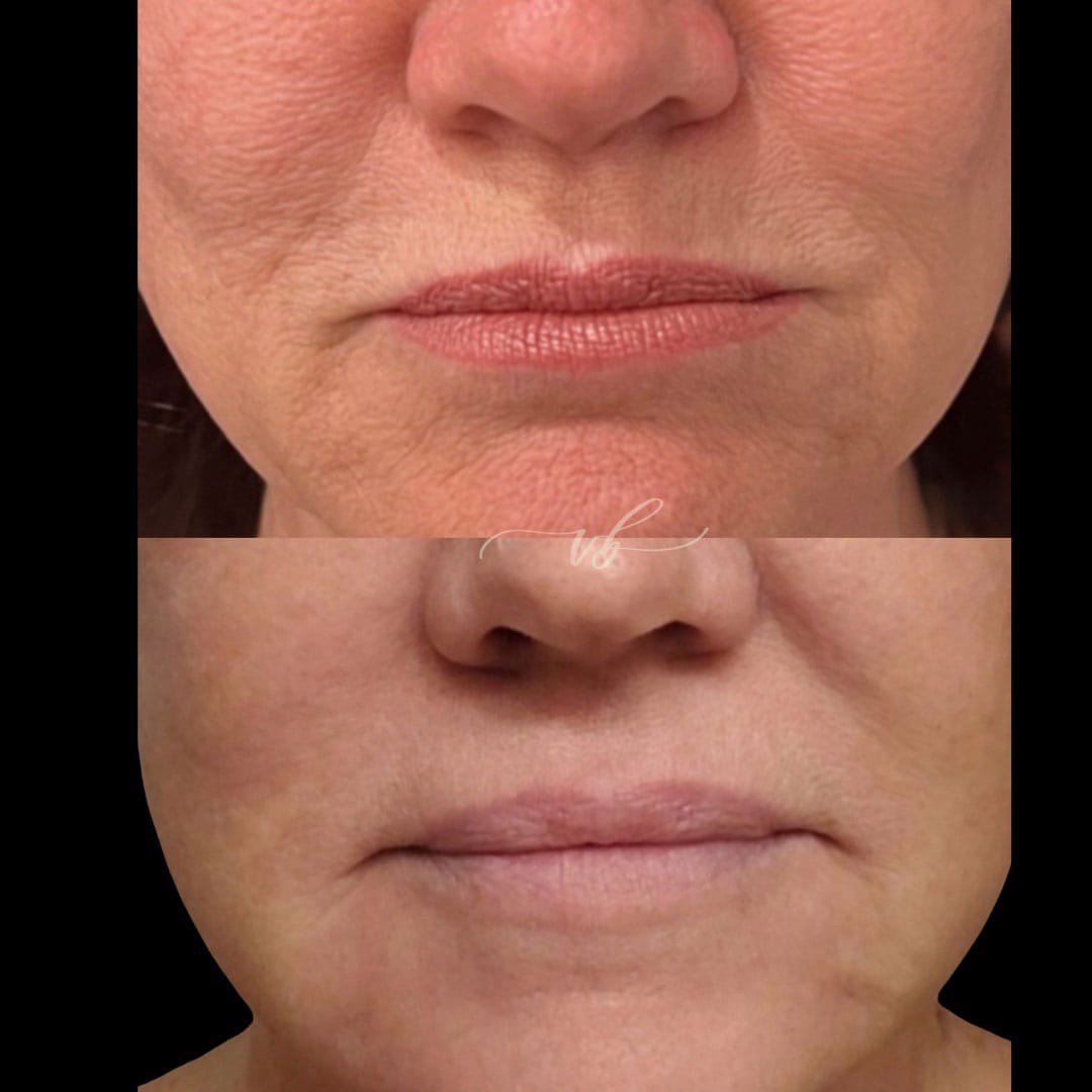 Before and after fractional laser resurfacing for skin texture at Vida Bela Laser Center.