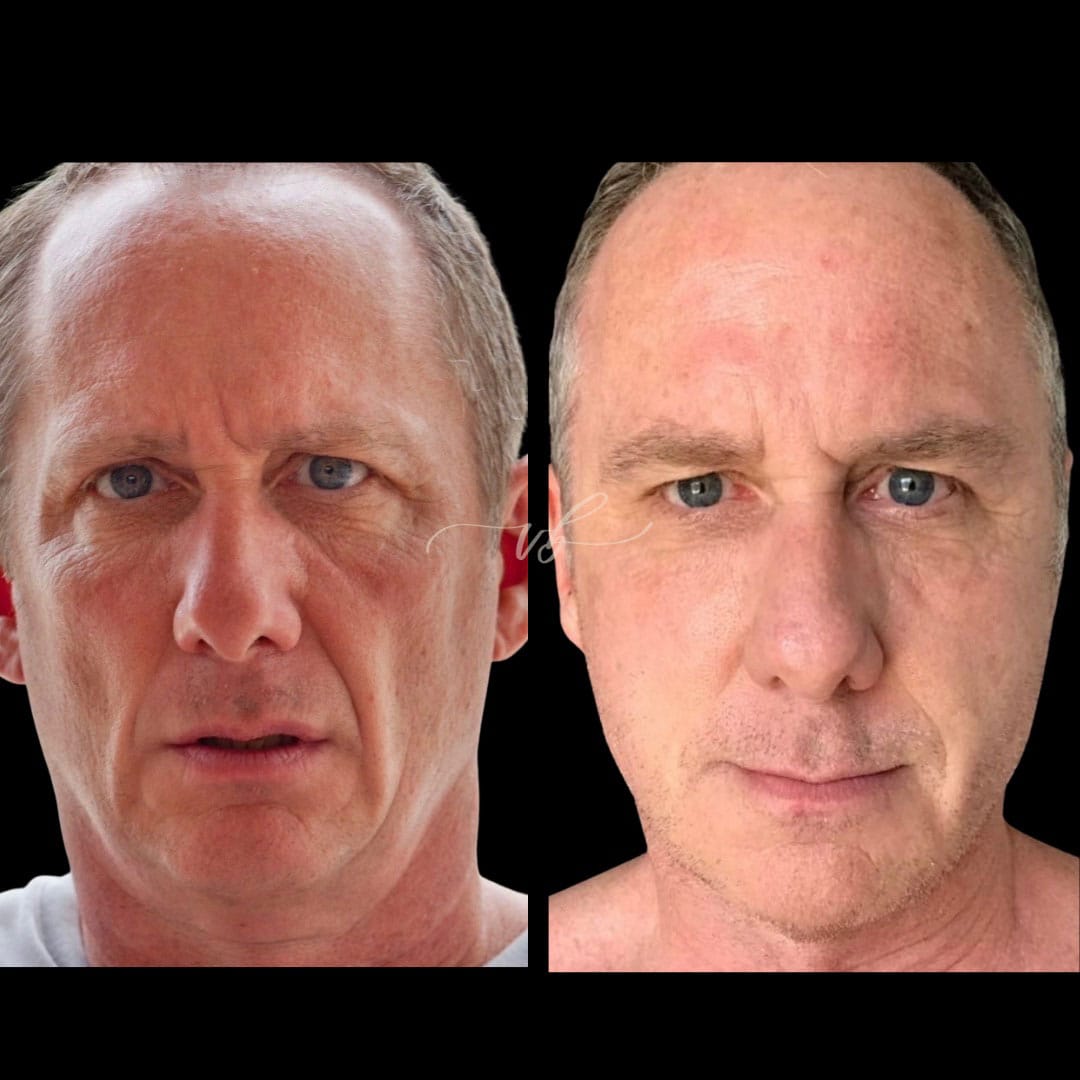 Before and after CO2 laser resurfacing at Vida Bela Laser Center.