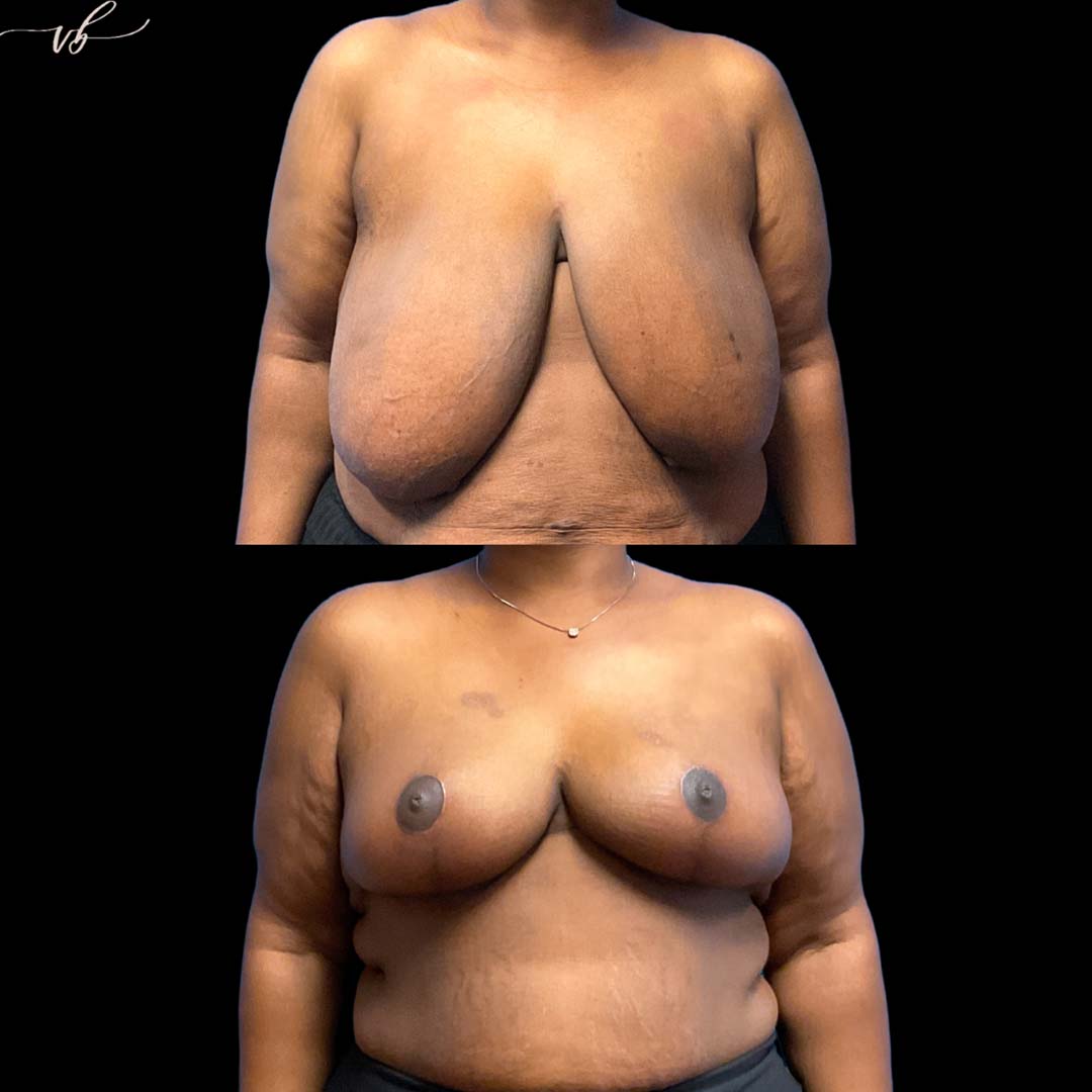 Breast lift before and after 3