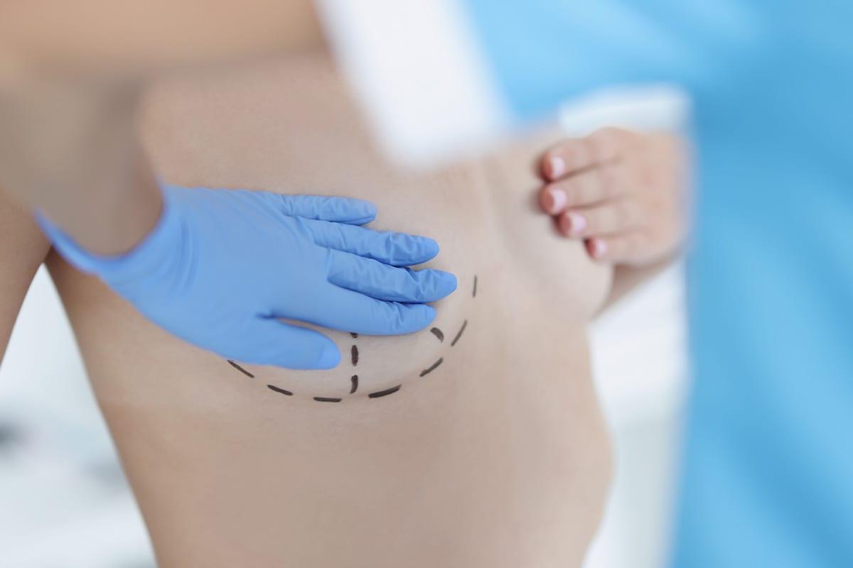 Breast lift incision planning at Vida Bela Plastic Surgery