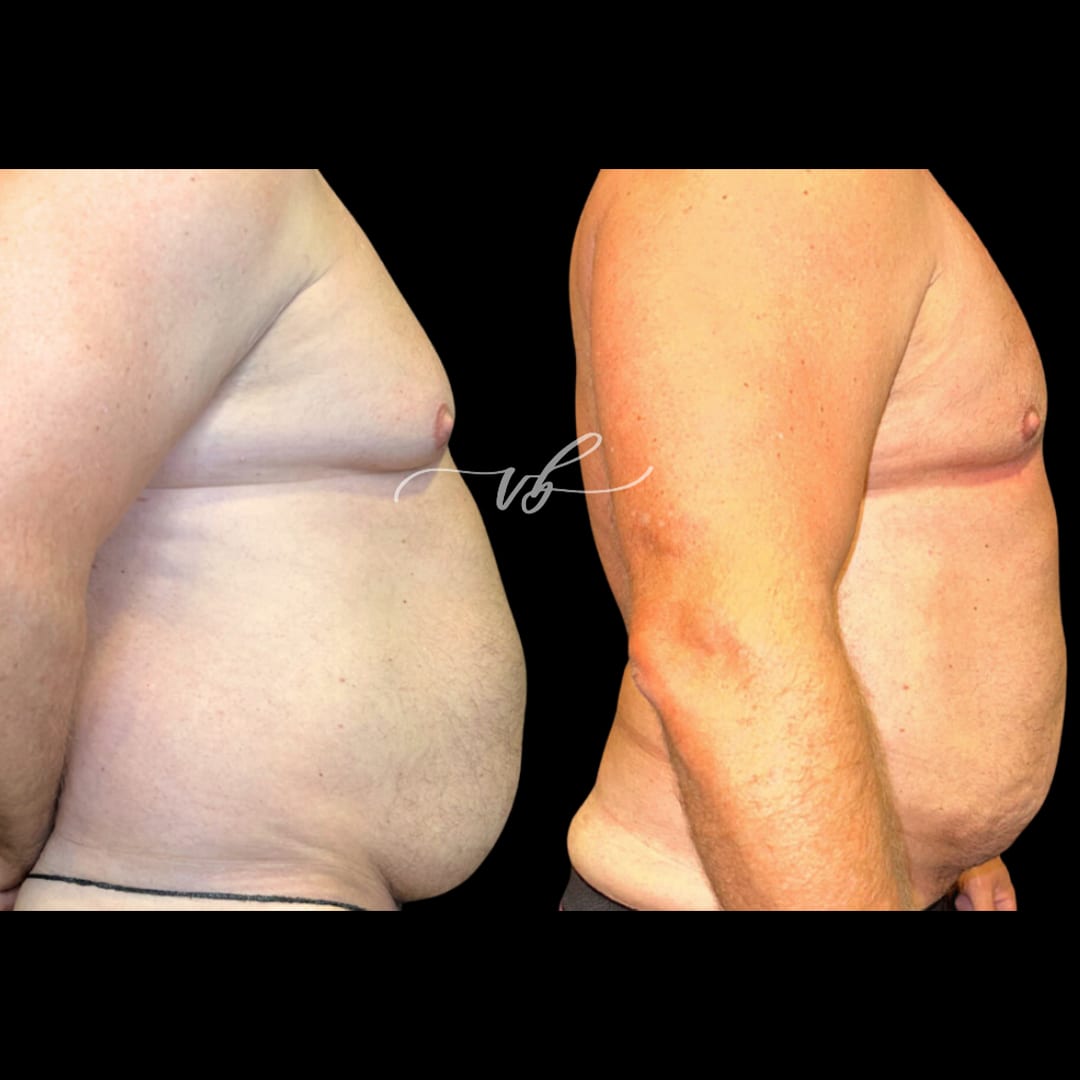 Liposuction before and after 1