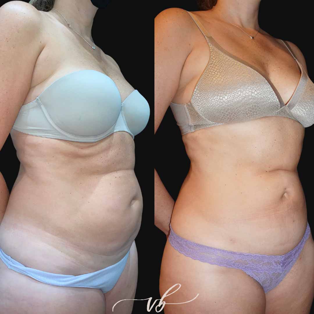 Liposuction before and after 2