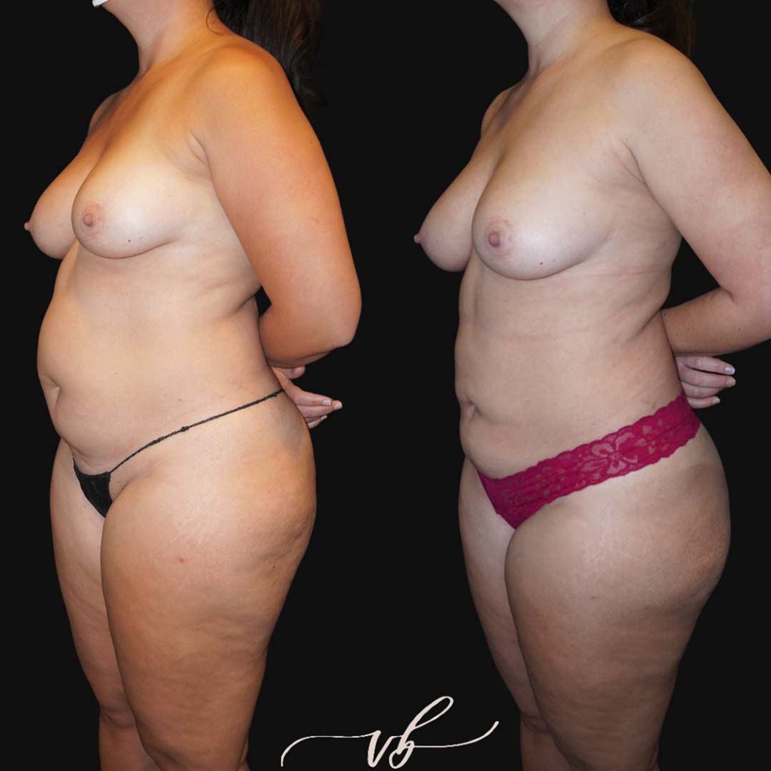 Liposuction before and after 3