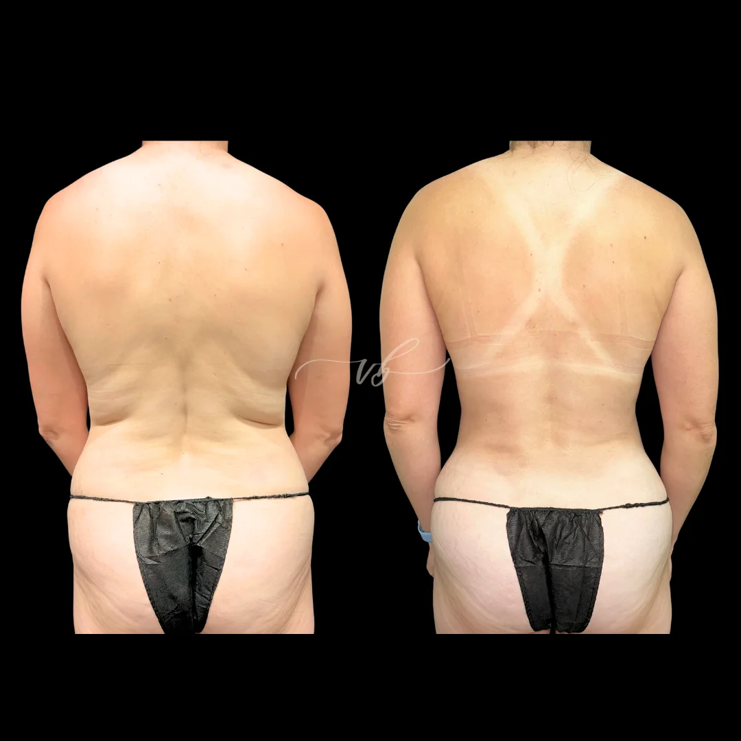 Liposuction before and after 4
