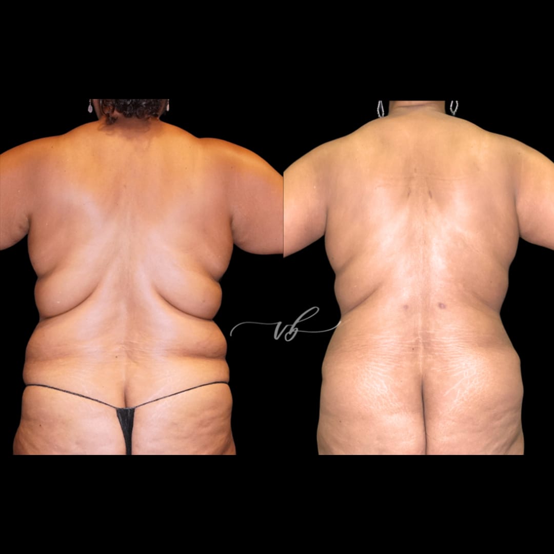 Liposuction before and after 5