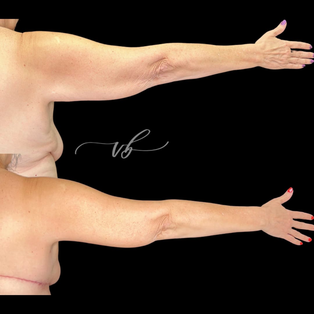 Liposuction before and after 7