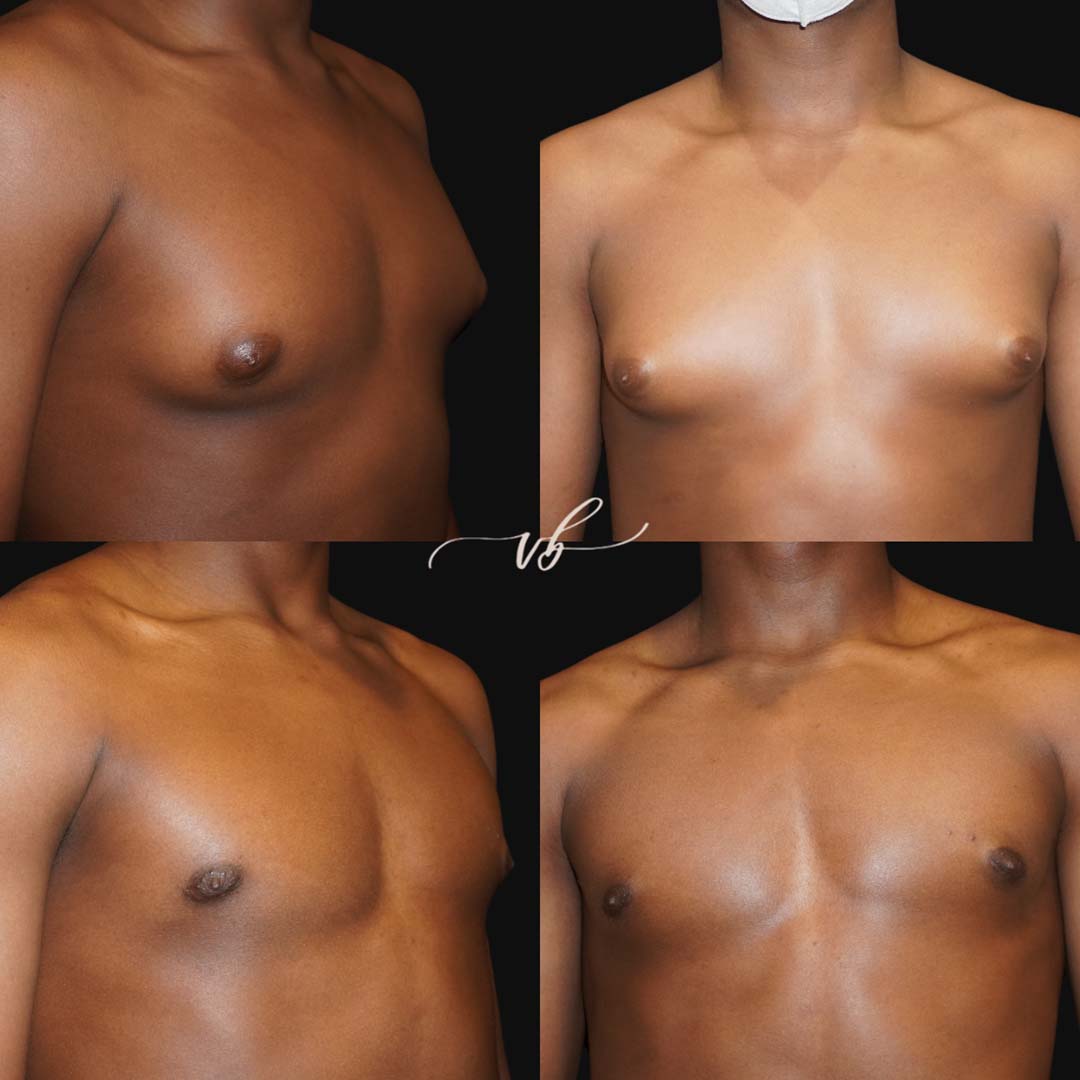 Gynecomastia before and after images of male plastic surgery in Plano.