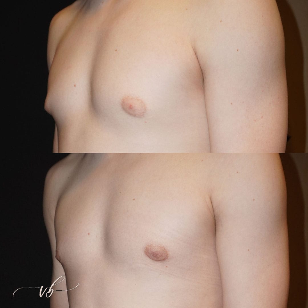 Gynecomastia before and after images of male plastic surgery in Plano.
