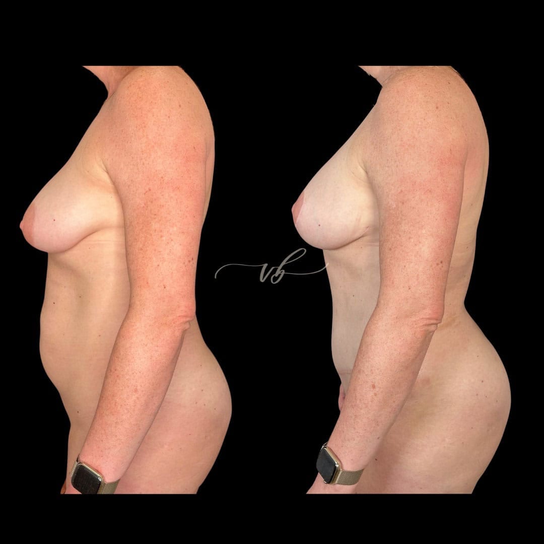 Mommy makeover before and after 2