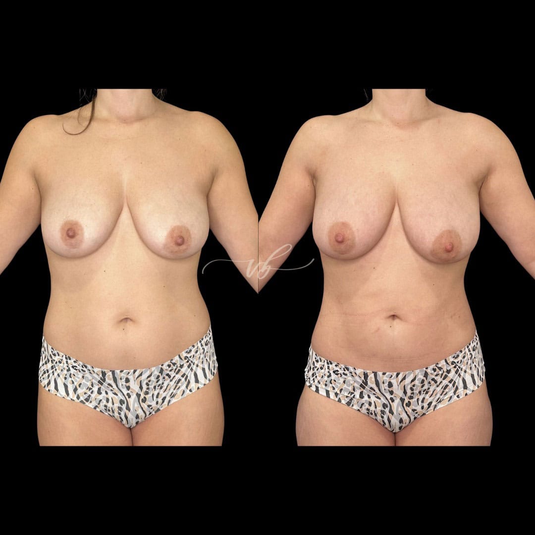 Mommy makeover before and after 3