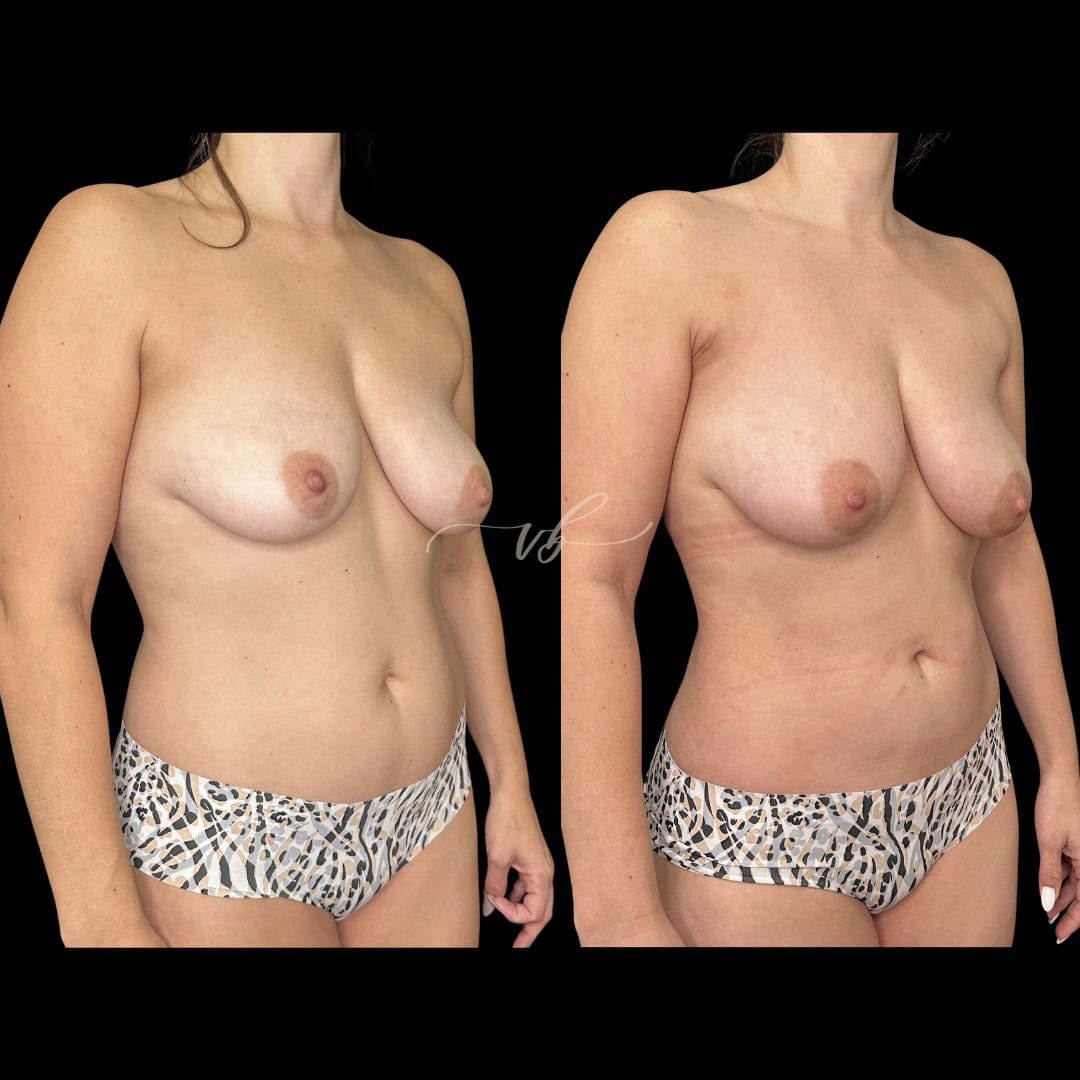 Mommy makeover before and after 4