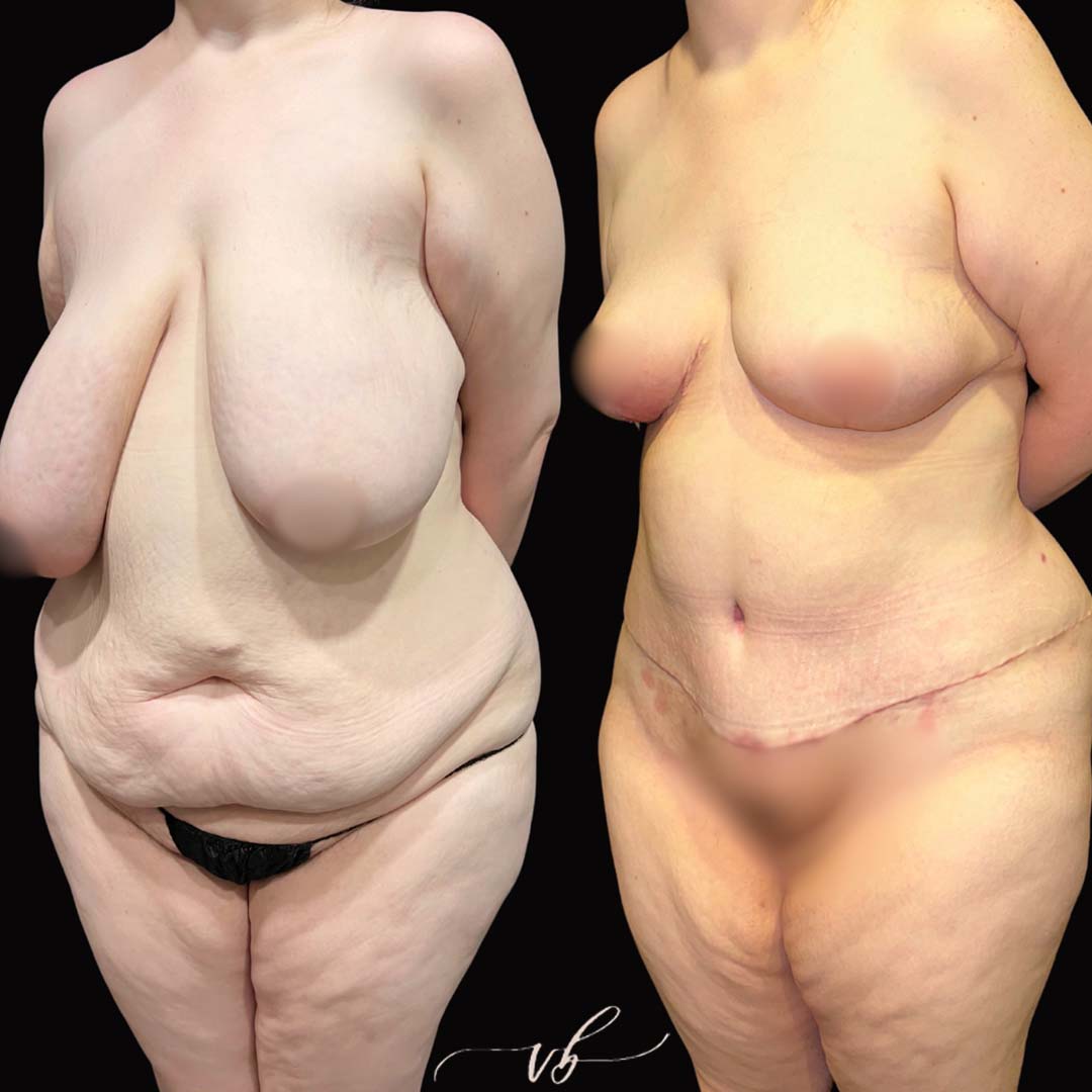 Mommy makeover before and after 5