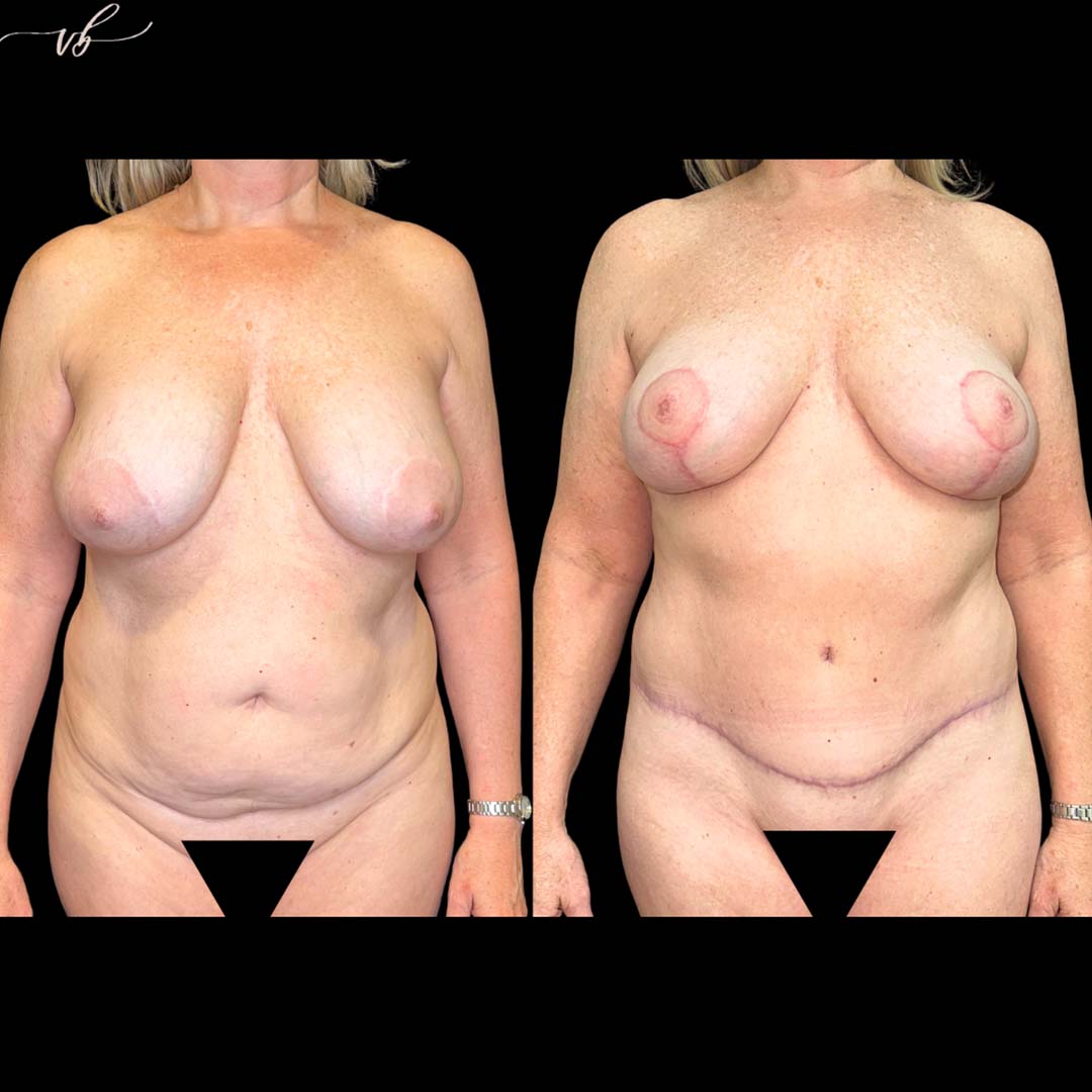 Mommy makeover before and after 6