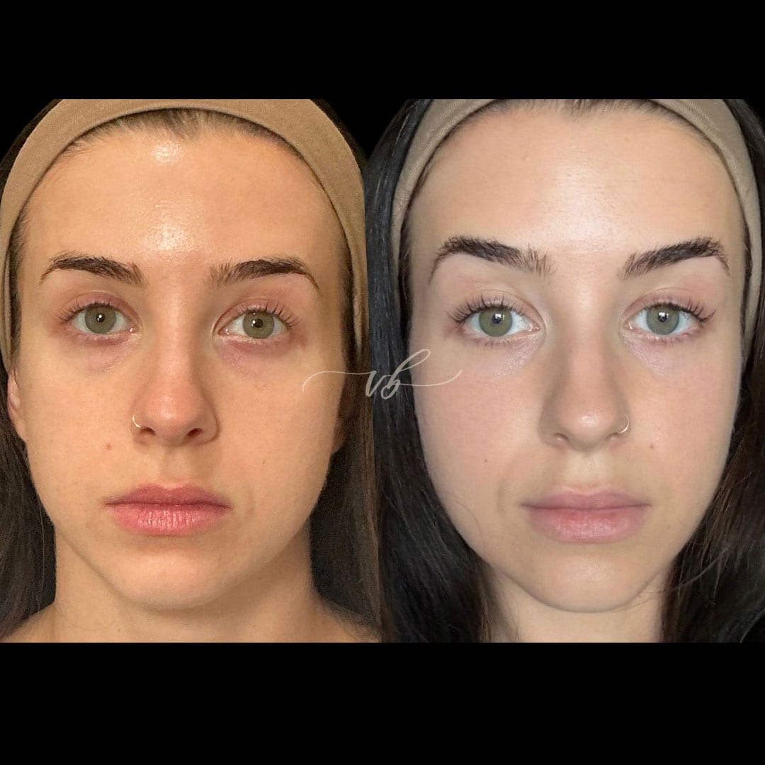 Before and after laser pigment correction at Vida Bela Laser Center.