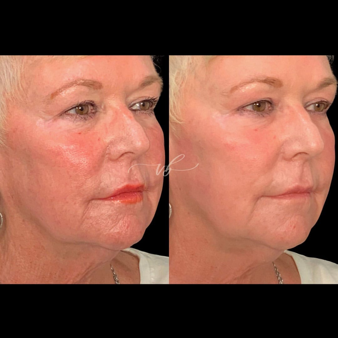 Before and after laser treatment for uneven tone and sun damage at Vida Bela Laser Center.