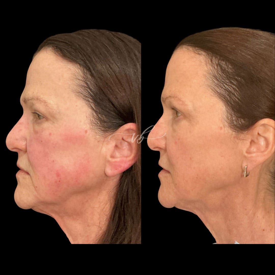 Before and after one Regenerative Maintenance session for overall skin quality at Vida Bela Laser Center in Plano.