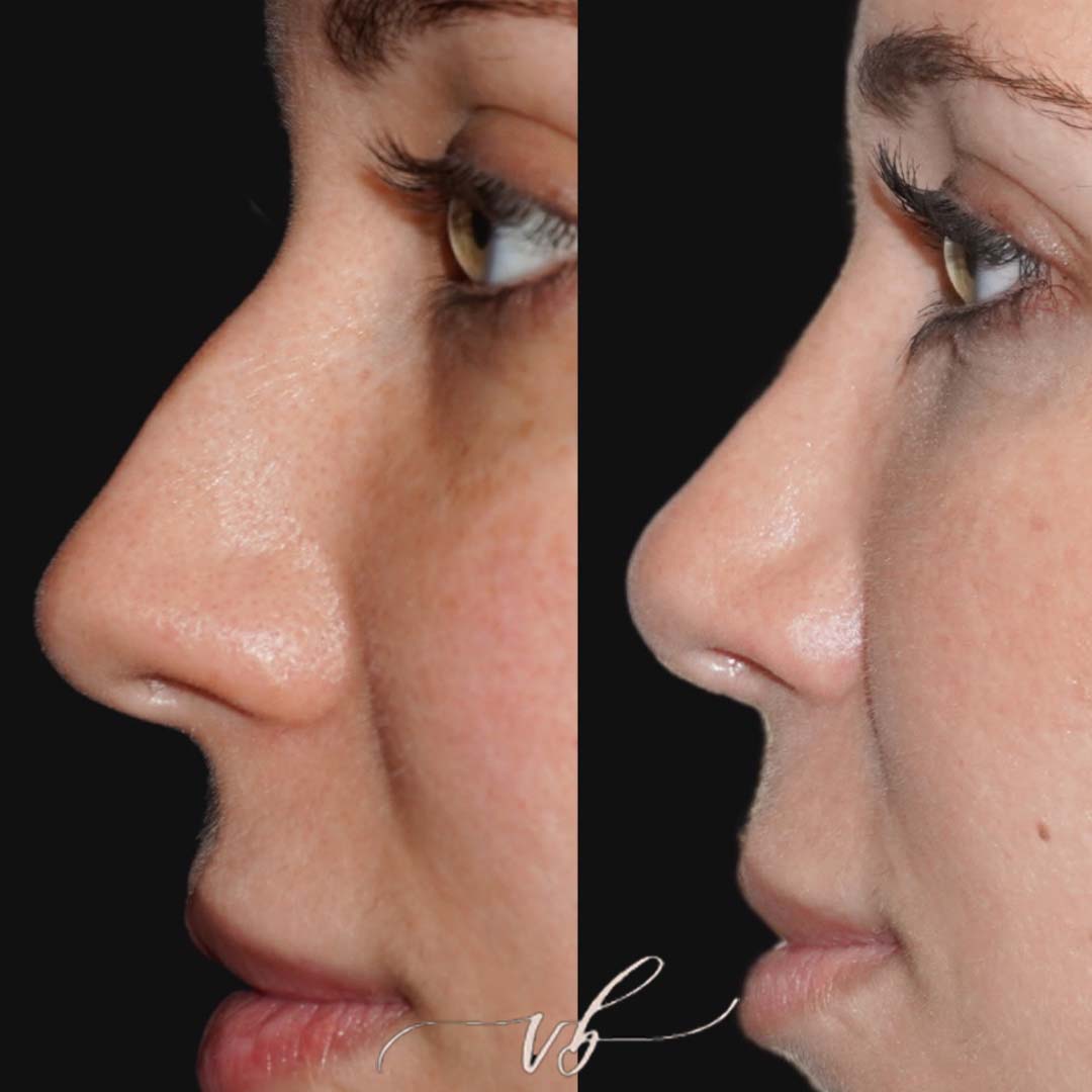 Rhinoplasty before and after 2