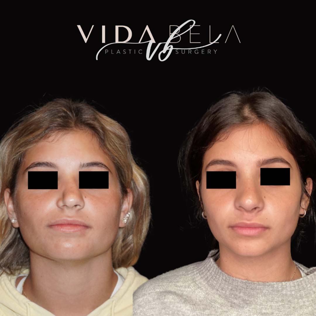 Rhinoplasty before and after 1