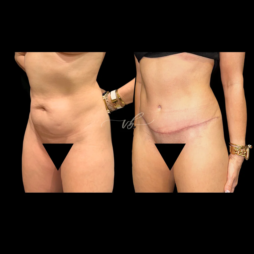 Tummy tuck before and after 2
