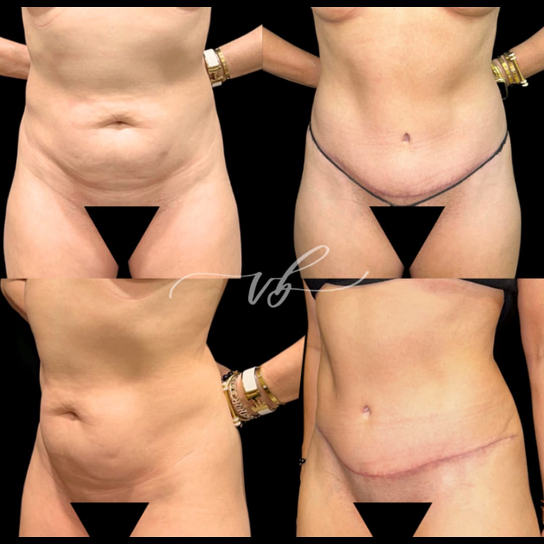 Tummy tuck before and after 3