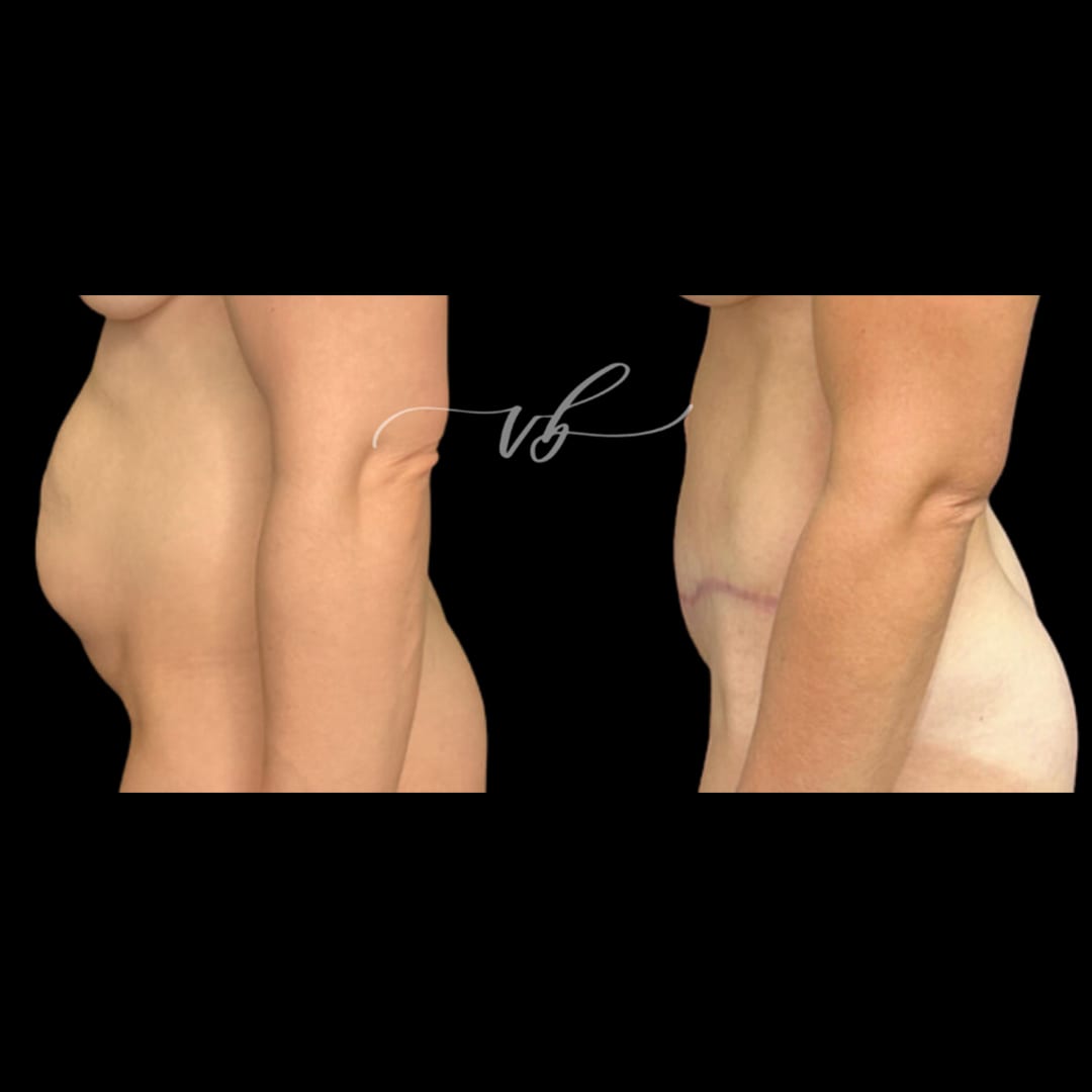 Tummy tuck before and after 4
