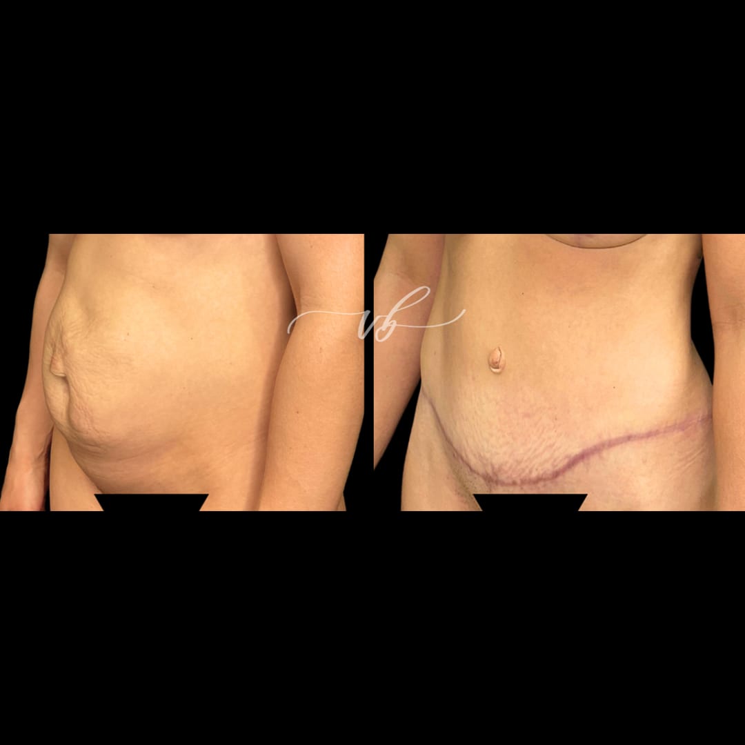 Tummy tuck before and after 5