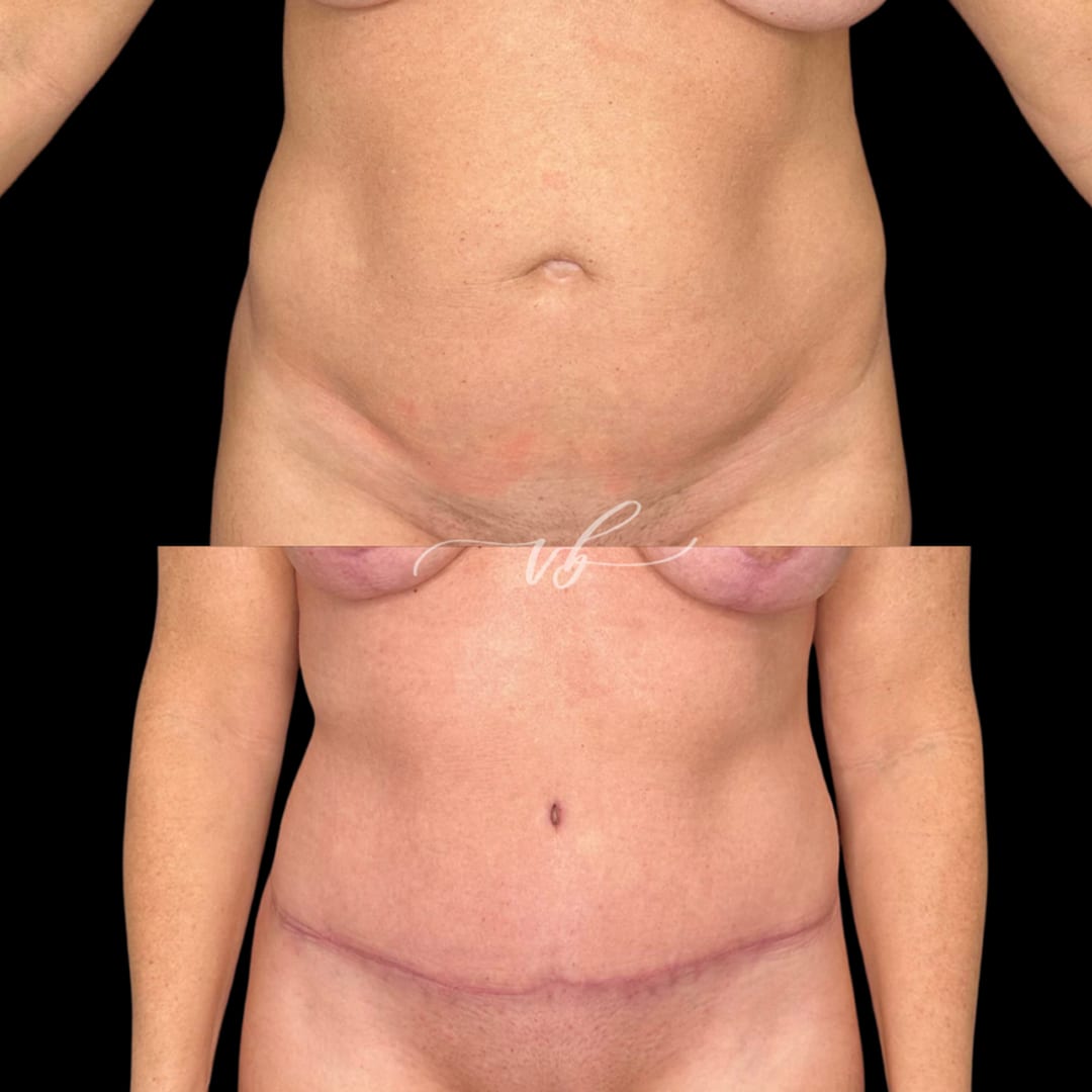 Tummy tuck before and after 6