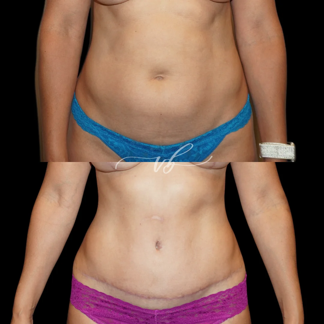 Tummy tuck before and after 7